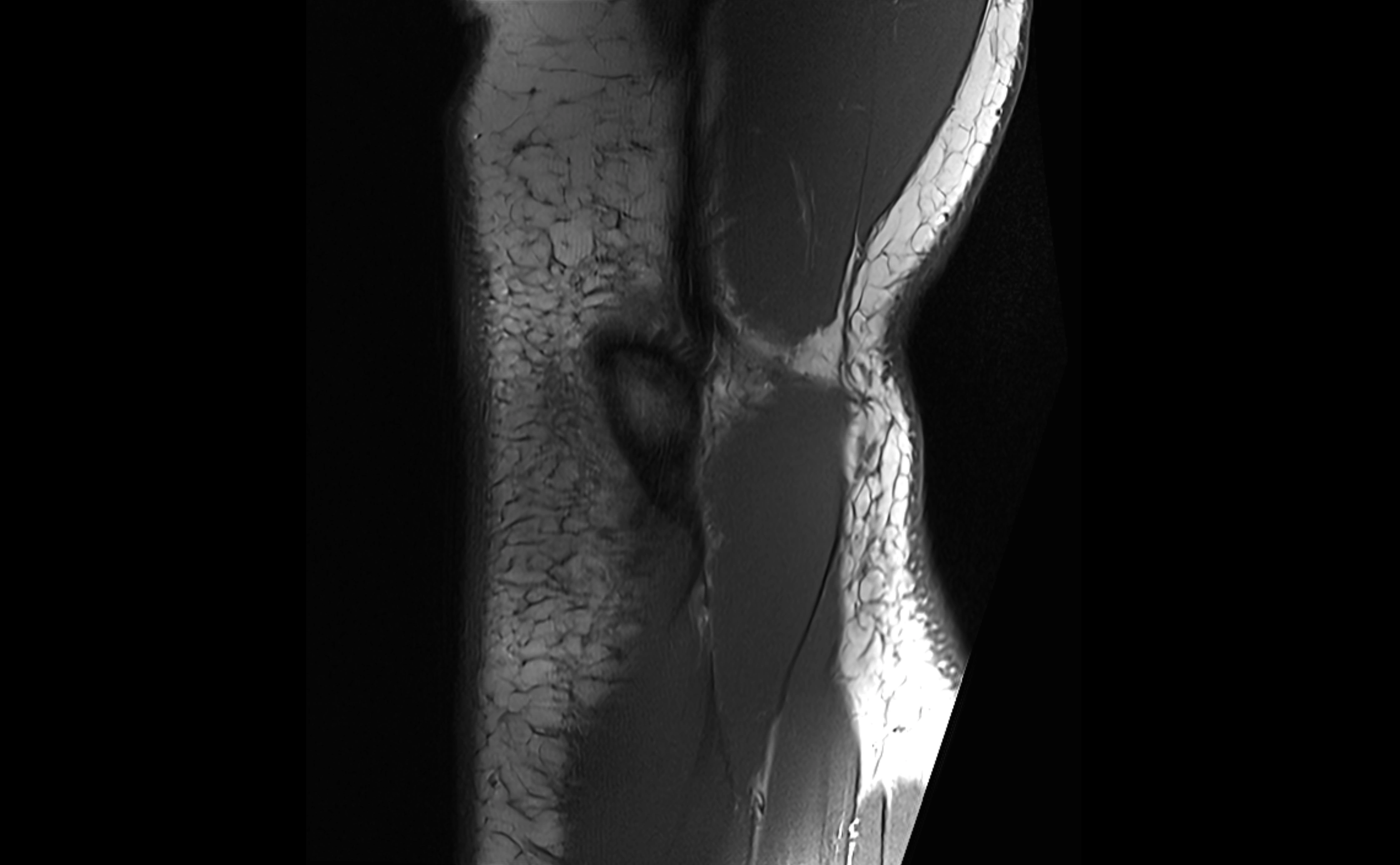 MRI elbow ligaments coronal cross sectional anatomy 3T  radiology  image-img-07001-00030.webp